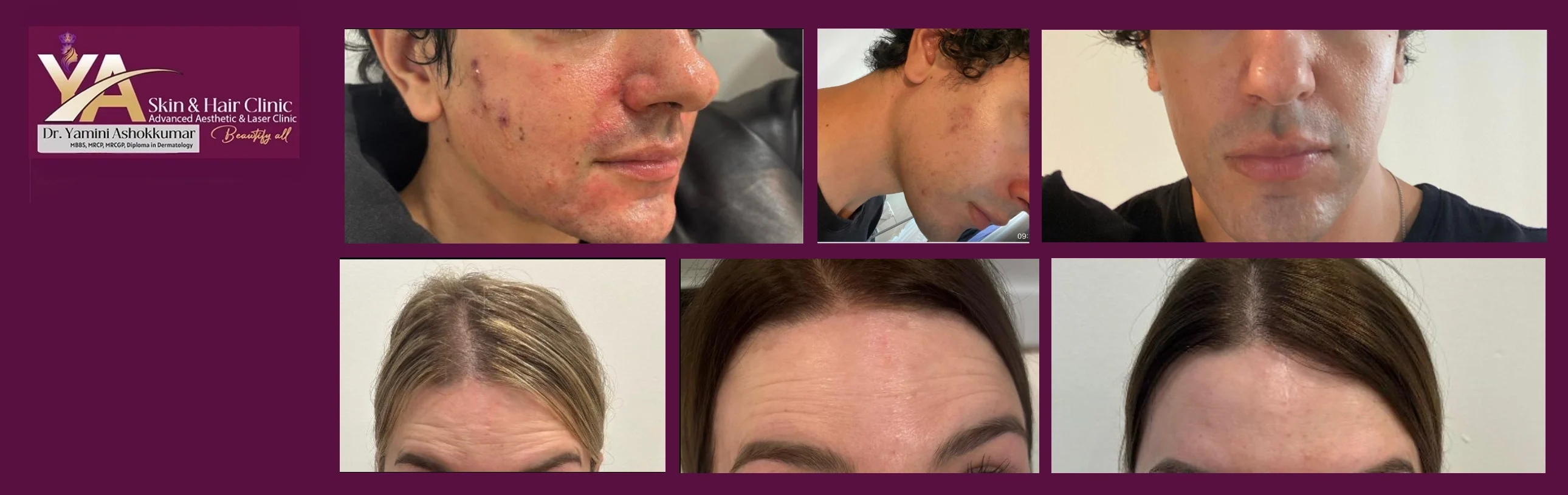 Why Aftercare and Maintenance Treatments Are Essential for Long-Term Aesthetic Results