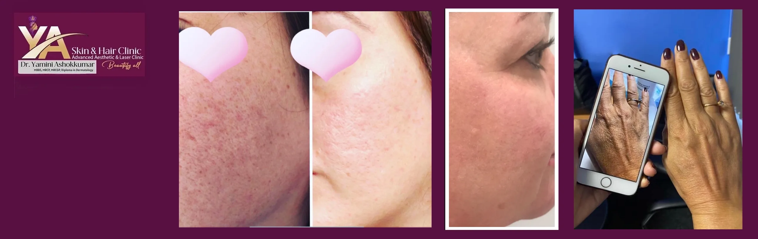 Pigmentation Treatment in Skin Types 4–6: Why It Can Be More Challenging and How Expert Care Makes the Difference
