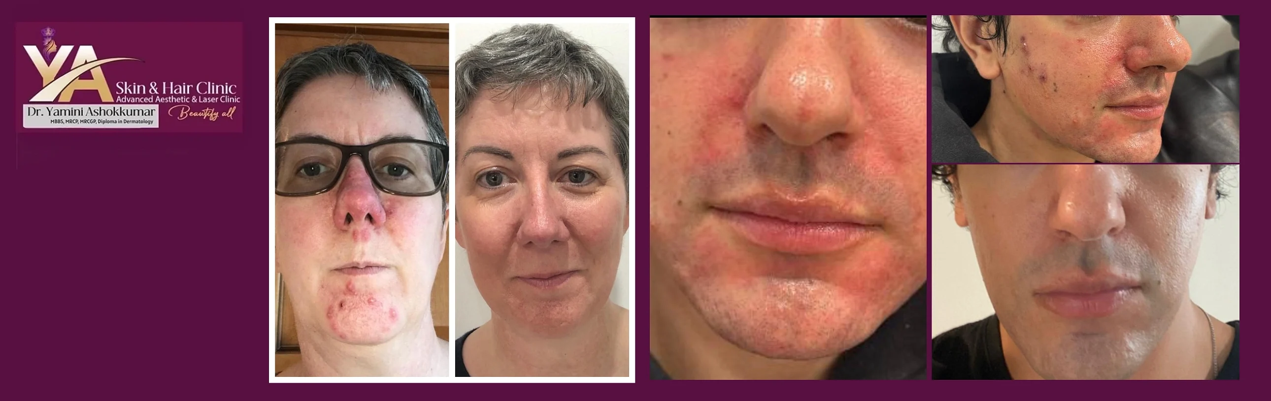 Acne Treatment: Beyond Your Dermatology Prescription – What Else Can Be Done?