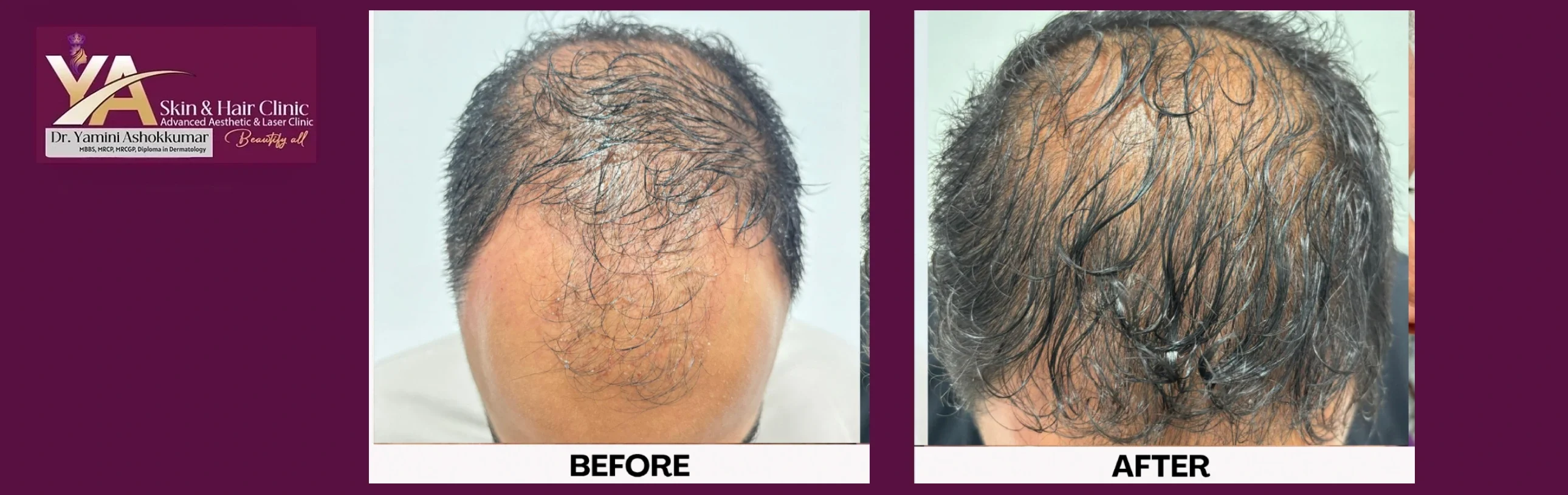 PRP Treatment: More Than Just Hair Growth – The Science of Natural Regeneration