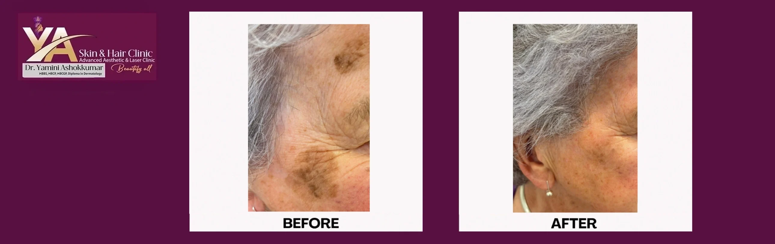 Cryotherapy Treatment: A Fast, Safe, and Effective Solution for Benign Skin Lesions