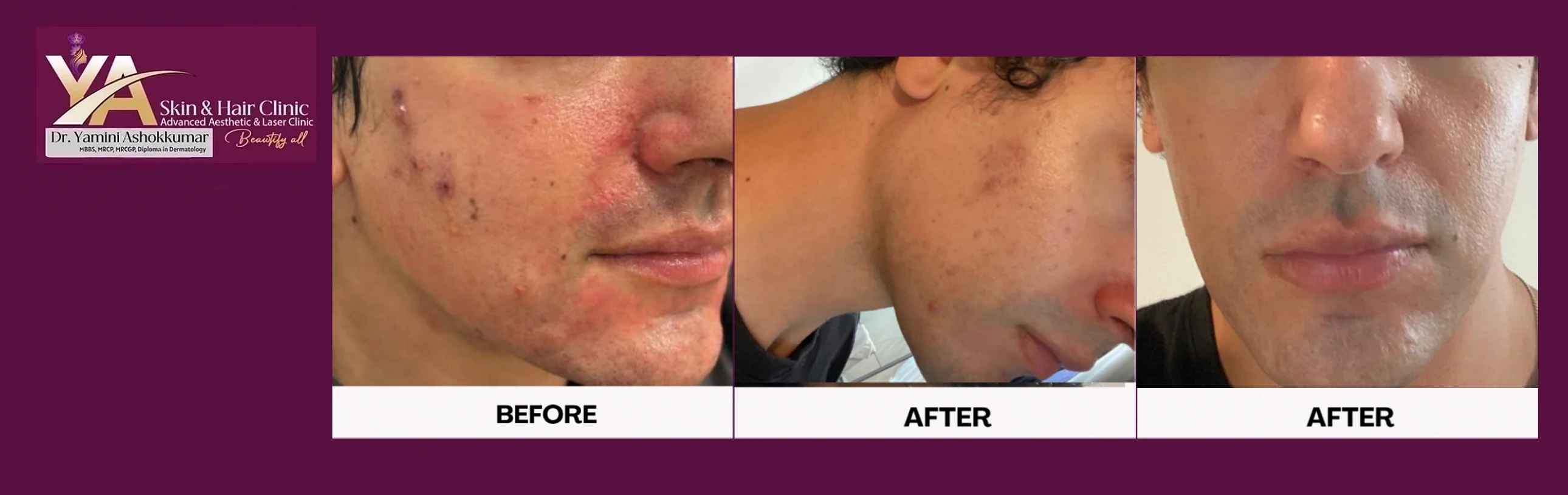 Acne Treatment: A Personalised Journey to Clearer, Healthier Skin