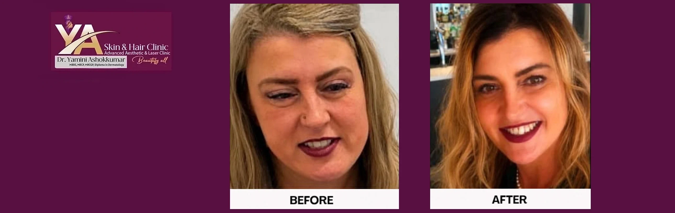 Non-Surgical Blepharoplasty: A Modern Alternative to Eyelid Surgery