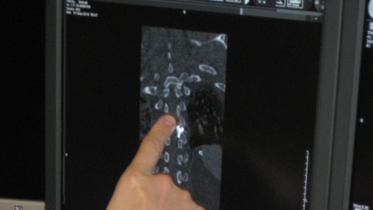 One step closer to a potential cure for paralysis