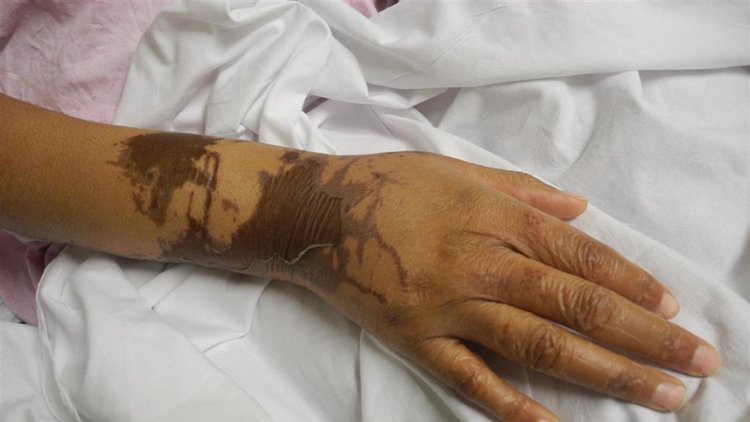 Stephen Timms MP: Swift action needed to prevent rising numbers of 'abhorrent' acid attacks