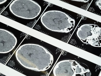 Успешная операция в биофизическом центре имени А. И. Бурназяна