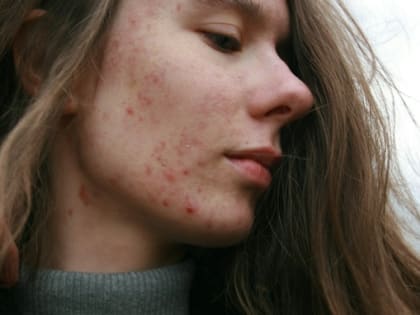 Дерматолог рассказала, почему весной становится много прыщей