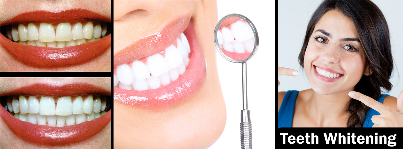 Teeth Whitening Treatment at Ridgeway Dental Spa Hinjewadi Pune
