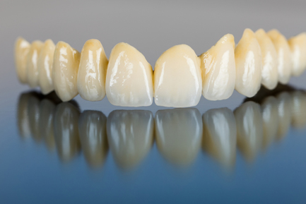 Crowns and Bridges at Ridgeway Dental Spa