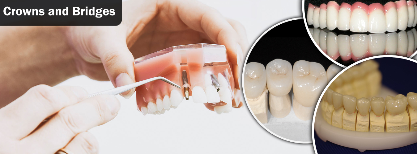 Dental Crowns and Bridges Treatment at Ridgeway Dental Spa Hinjewadi Pune