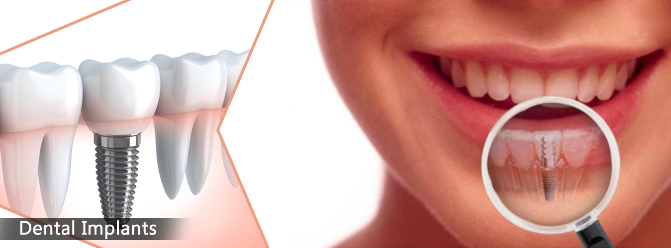Dental Implant Treatment at Ridgeway Dental Spa Hinjewadi Pune