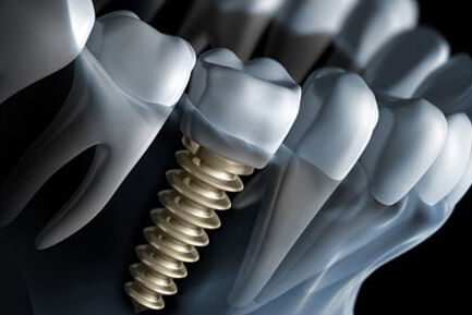 Dental Implant at Ridgeway Dental Spa Hinjawadi