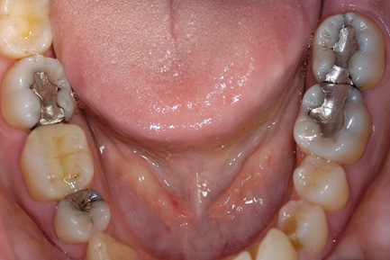 Cosmetic Filling at Ridgeway Dental Spa Hinjawadi