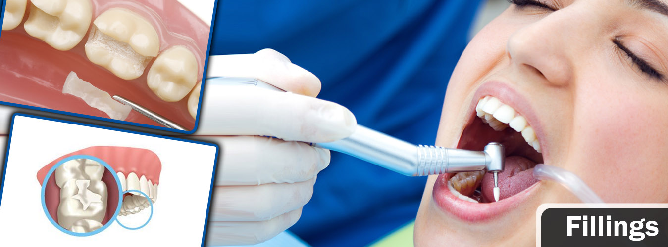 Dental Fillings Treatment at Ridgeway Dental Spa Hinjewadi Pune