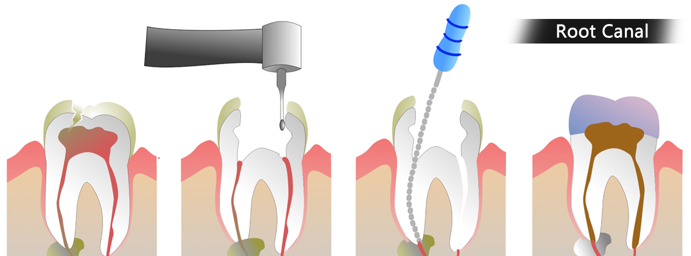 Root Canal Treatment at Ridgeway Dental Spa Hinjewadi Pune