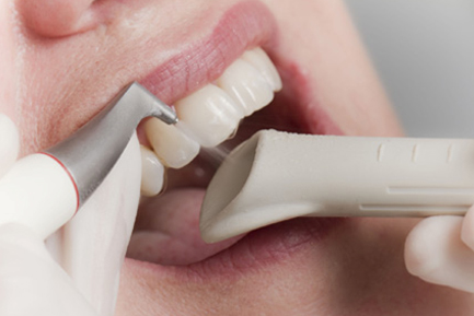 Teeth Cleaning at Ridgeway Dental Spa Hinjawadi