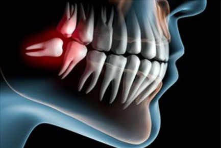 Wisdom Tooth at Ridgeway Dental Spa Hinjawadi