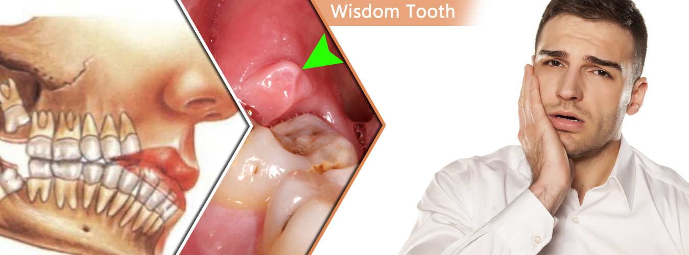 Wisdom Tooth Removal Surgery at Ridgeway Dental Spa Hinjewadi Pune