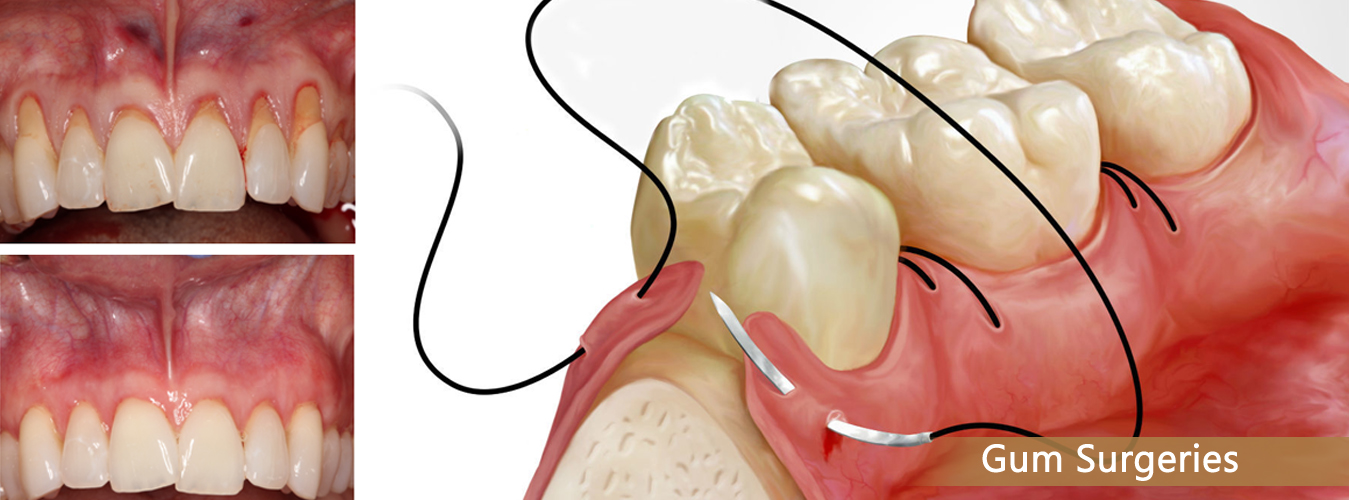 Laser Gum Surgery at Ridgeway Dental Spa Hinjewadi Pune