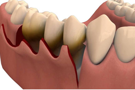 Gum Surgery at Ridgeway Dental Spa Hinjawadi