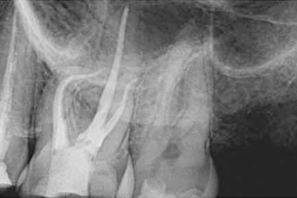 Root Canal at Ridgeway Dental Spa Hinjawadi