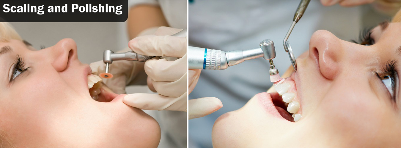 Teeth Scaling and Polishing at Ridgeway Dental Spa Hinjewadi Pune