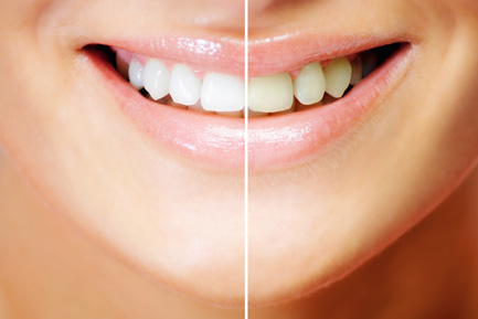 Teeth Whitening at Ridgeway Dental Spa Hinjawadi