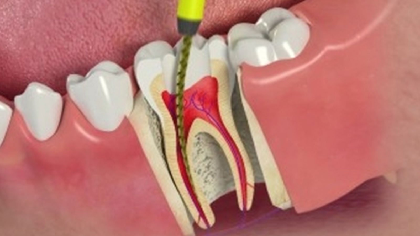 Expert Root Canal Treatment in Hinjewadi – Restore Your Smile with Confidence