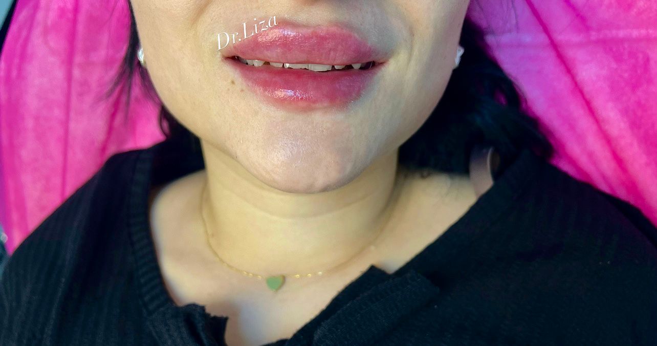 Lip Filler Before & After