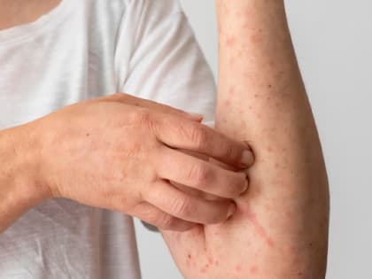 Обстановка напряженная. На Южном Урале не снижается заболеваемость ОРВИ и гриппом