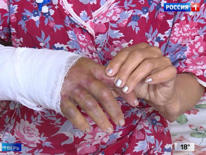 Укус змеи стал причиной экстренной госпитализации женщины из Лихославля