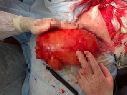 Уникальный случай в Твери: врачи удалили гигантскую липому