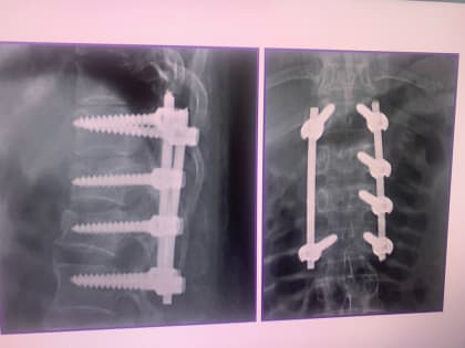 Первая операция по фиксации позвоночника у ребёнка в нейрохирургии