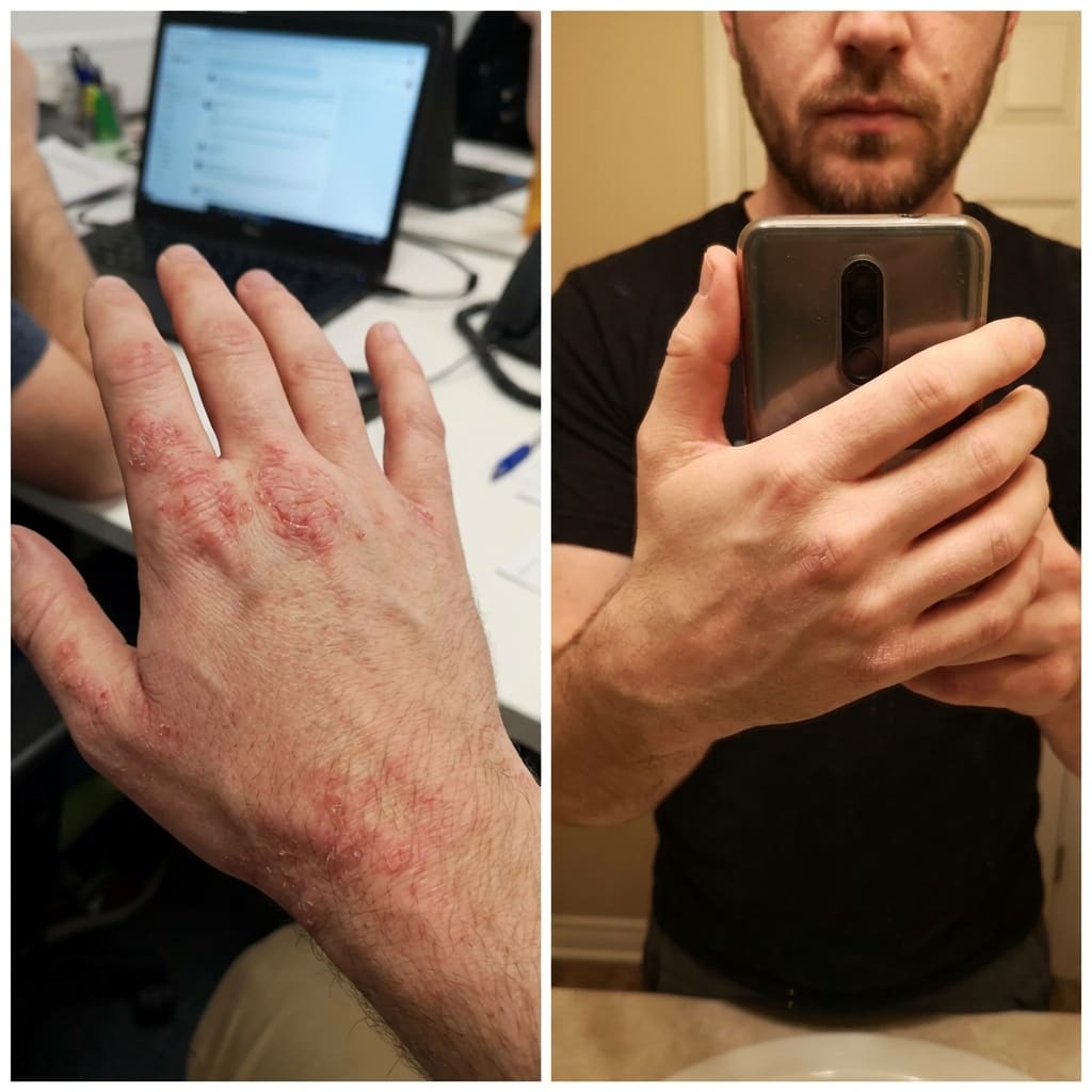 Before and after eczema treatment