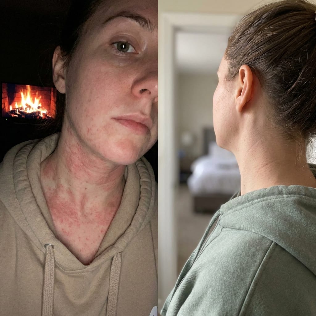 Before and after eczema treatment