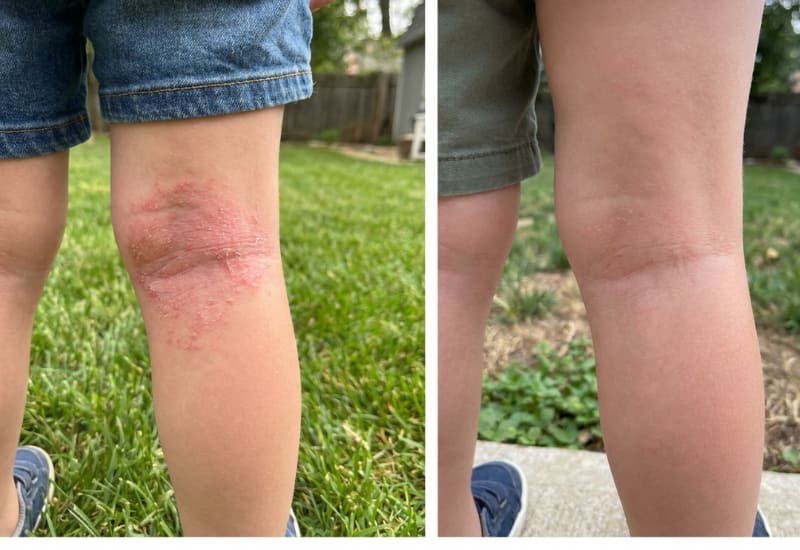 Before and after eczema treatment