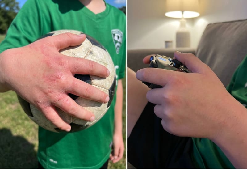 Eczema treatment