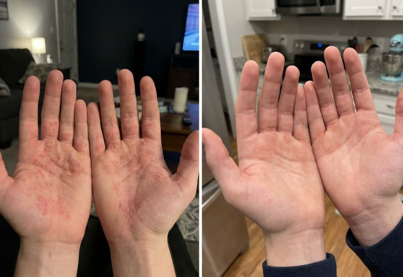 Before and after eczema treatment