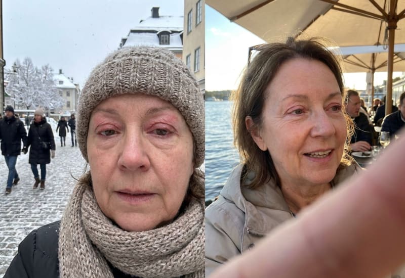 Face and eyelid eczema before and after