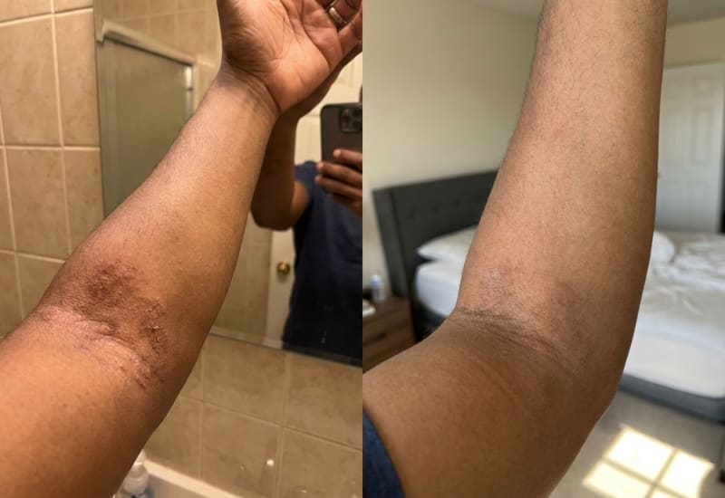 Eczema treatment