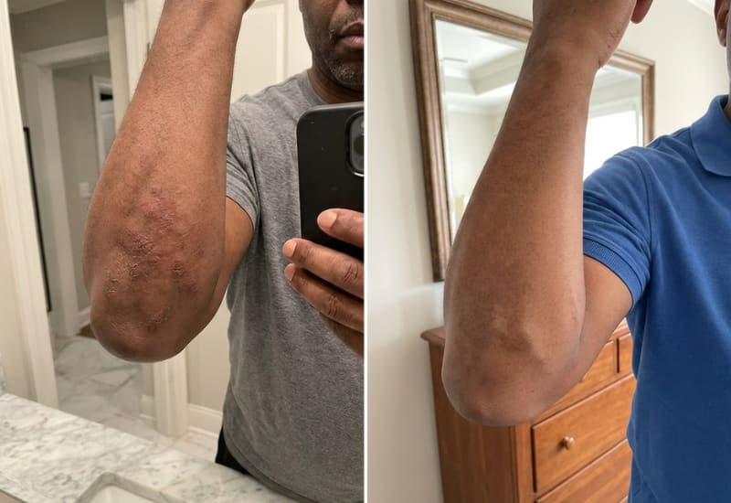 Elbow and knee eczema before and after