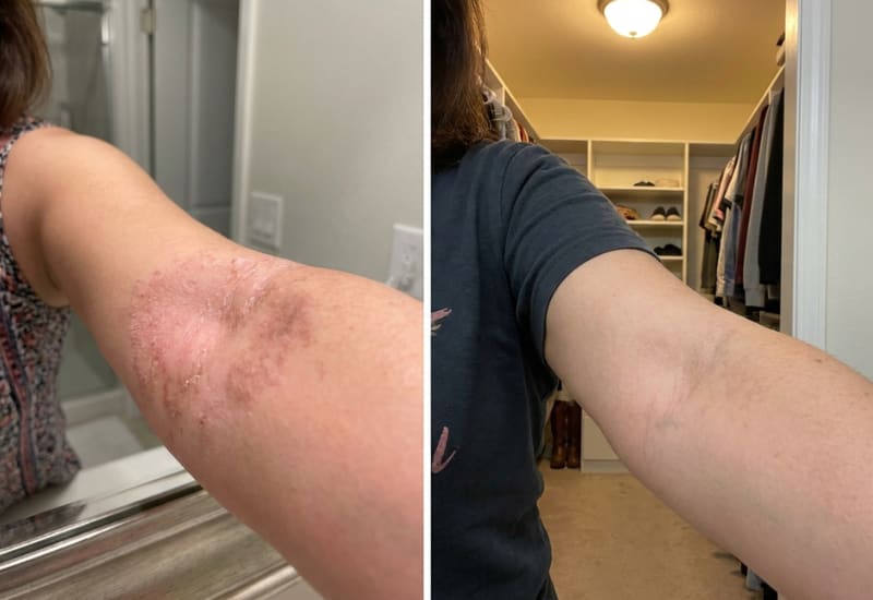 Forearm and knee fold eczema before and after