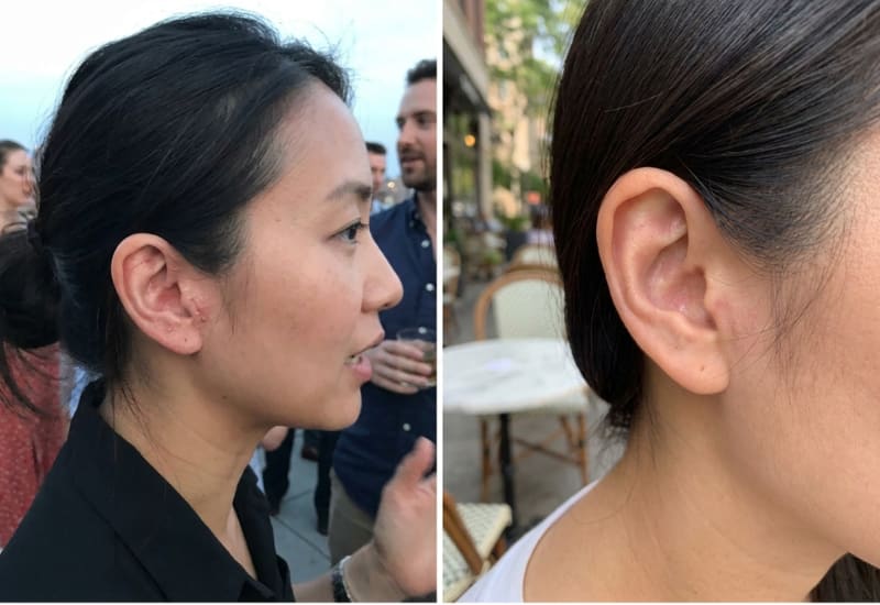 Neck and ear eczema before and after
