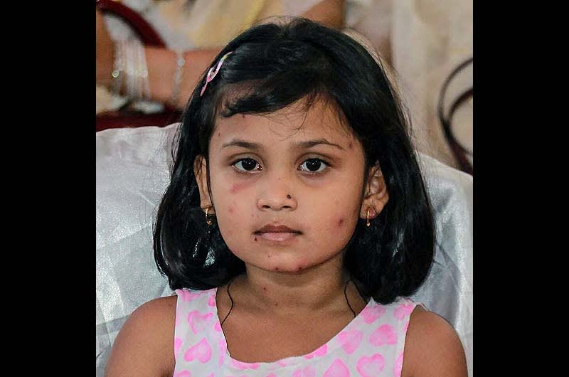 9,300 cases of chickenpox in the Gaza Strip, last two weeks. 9.300 casos de varicela en Gaza, las dos últimas semanas
