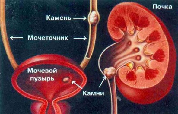 Приклад порушення, наслідком якого є анурія Приклад порушення, наслідком якого є анурія