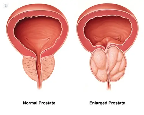 Foods to Avoid with Enlarged Prostate