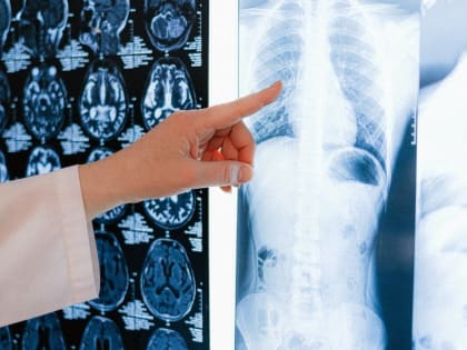 Увеличение случаев пневмонии в Алтайском крае: что нужно знать