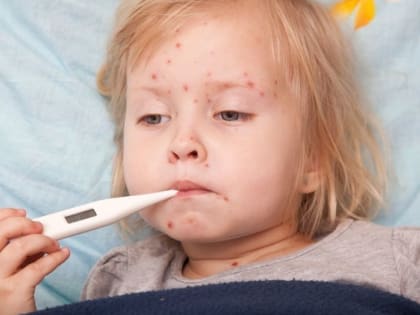 В Барнауле выявили один случай заболевания корью