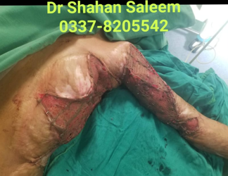 Axillary Contracture - After