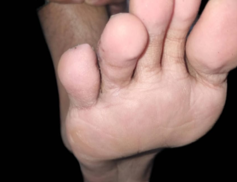 Syndactyly - After